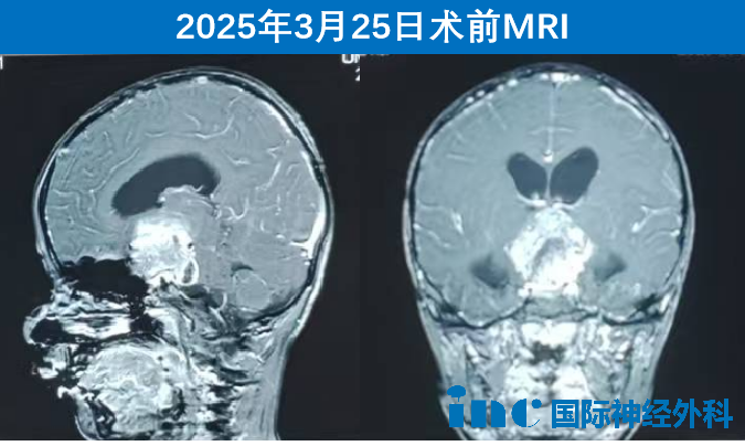 在苏州大学附属儿童医院，“神奇”的巴爷爷又为一名年仅5岁的视路胶质瘤患儿守护光明，让幼小的生命得以继续探索这绚烂春光！