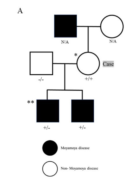 而在查看了她的家族史后，发现她的2个孩子和叔叔有典型的烟雾病和RNF213 p.R4810K杂合子变异，3人均进行了血运重建术。