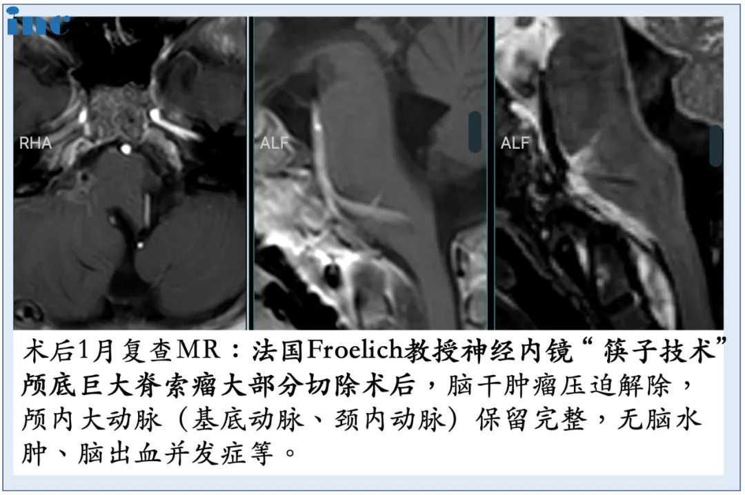 术后一个月复查时，MRI影像中显示林林颅内大动脉保留完整，并且无脑水肿，脑内出血并发症等。
