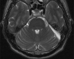 术后 MRI 图像显示肿瘤已完全切除。
