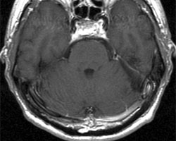 术后 MRI 图像显示肿瘤已完全切除。