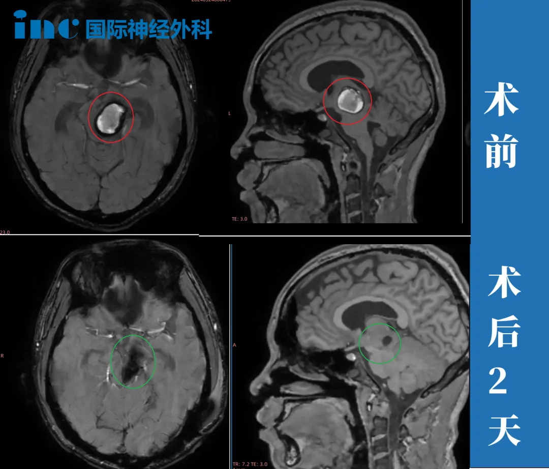 天没有塌！18岁中脑海绵状血管瘤少年术后重回校园