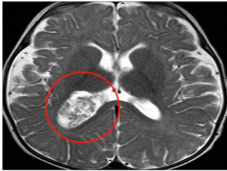 在SickKids，磁共振成像(MRI)显示，Oliver右侧脑室后角有一个大肿块，考虑脉络丛乳头状瘤病变，并有蒂连接，伴有中度脑积水。