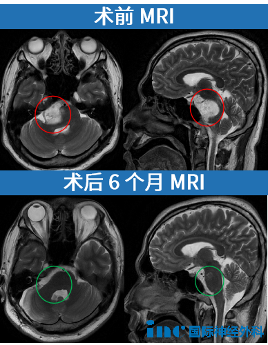 MRI影像