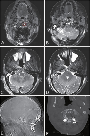 第二阶段远外侧入路开颅肿瘤切除术后影像学表现。(A-D)MRI T2 WI显示整个分期手术的脊索瘤完全切除，发现轻微的残留肿瘤(A图红色圆圈)。X偏(E)和CT(F)检查显示经后路手术椎体固定稳定。