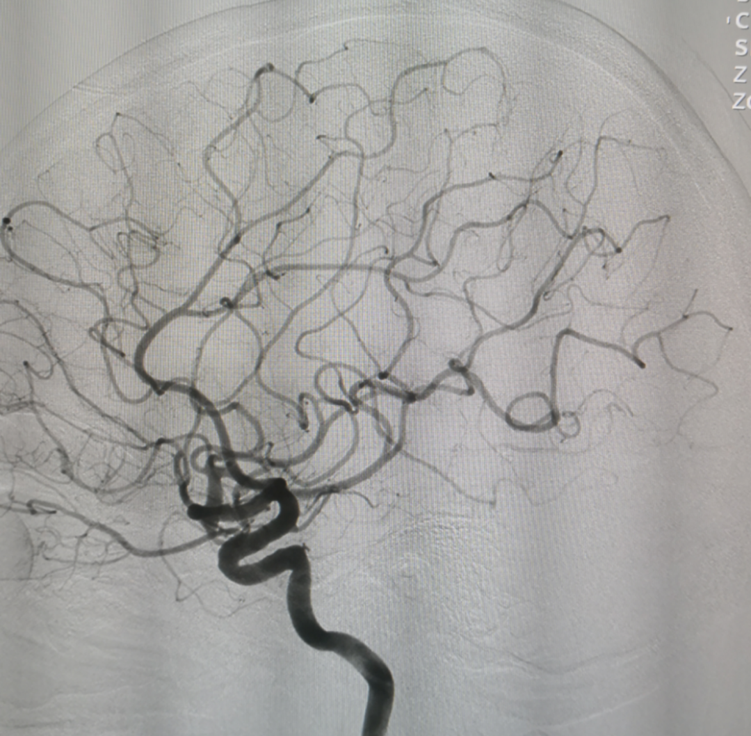 脑动静脉畸形(brain arteriovenous malformation)是一种先天性中枢神经系统血管发育异常的疾病。发生的主要改变是发病部位的动脉与静脉之间直接相通，使血管的网络出现问题，从而导致一系列血液流动变化的疾病。