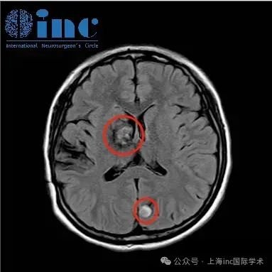 在做过核磁检查之后，发现原本在右侧基底节的病灶变大了，并且出现了新的出血在左顶叶枕区。