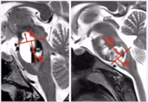 跨区域脑干海绵状血管瘤MRI