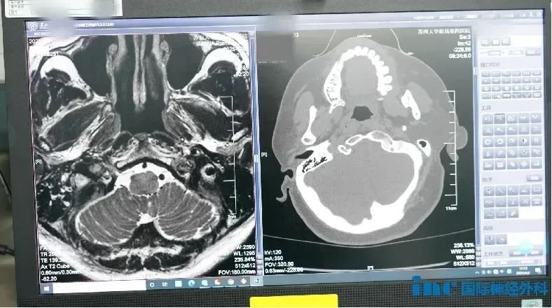 被颈静脉孔区隐蔽肿瘤折磨多时，如今的她“一天比一天好”!