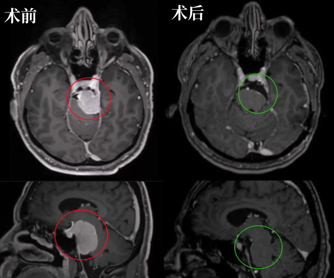 术前术后MRI影像