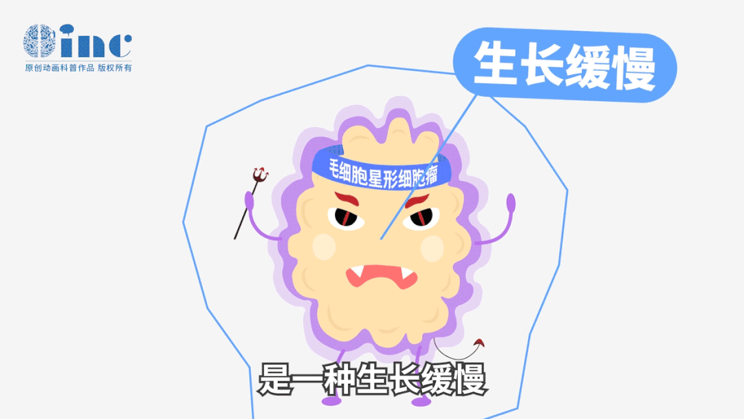 毛细胞型星形细胞瘤