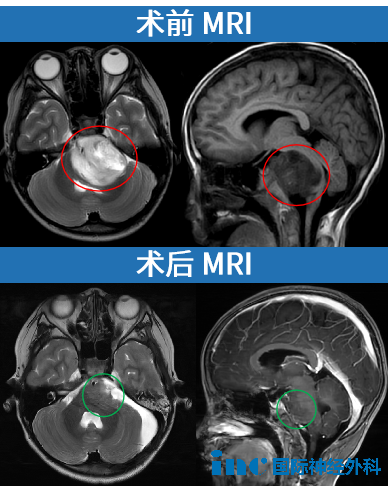 胶质瘤案例图片