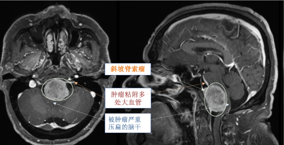 当脑干被巨大肿瘤压成＂纸片＂：一位斜坡脊索瘤患者的自救之路！
