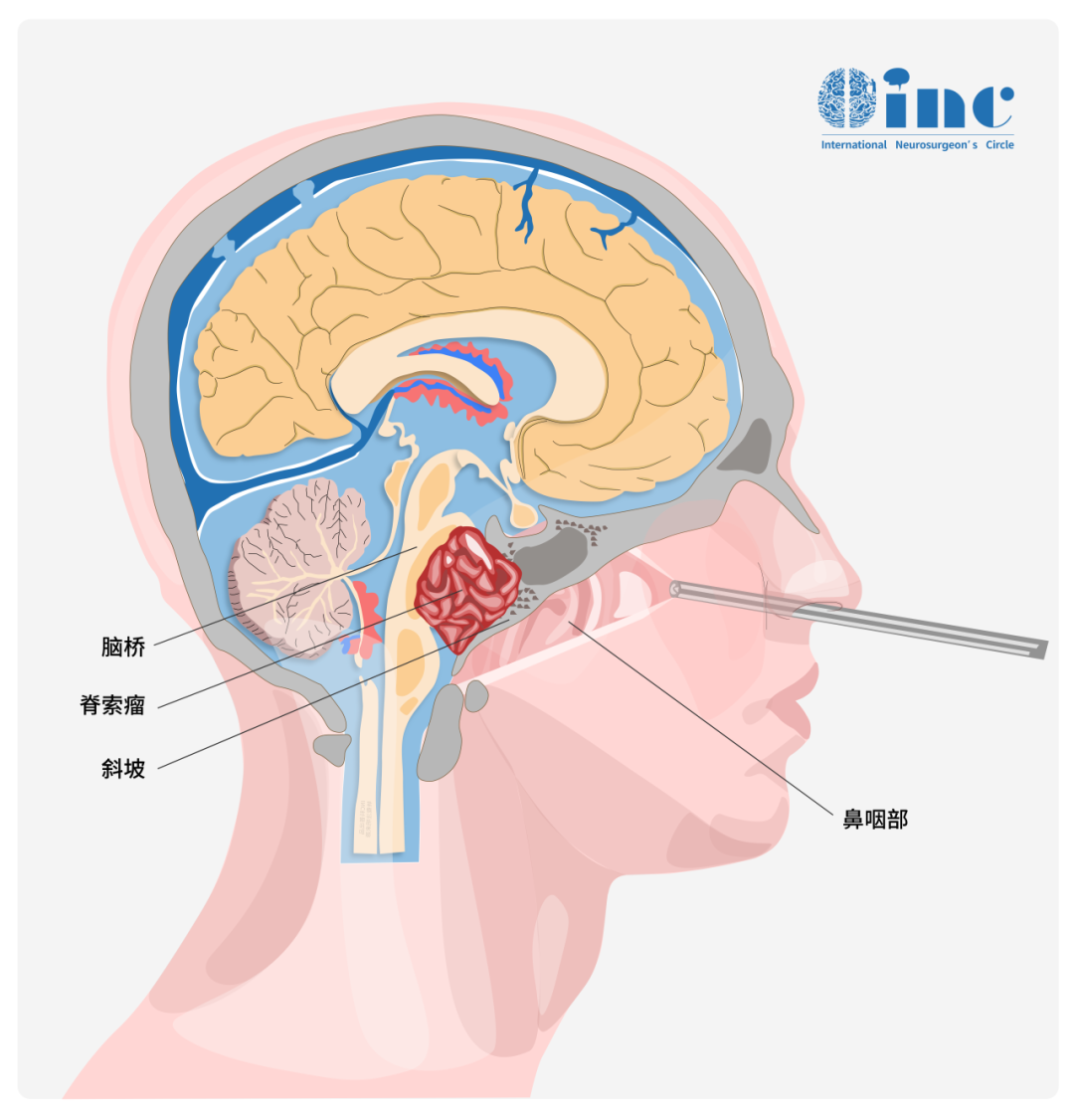 福教授耐心向我解释了我的肿瘤为什么很难全切：