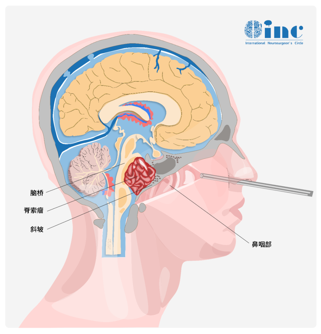 扩大经鼻入路与传统开颅手术不同的是，经鼻手术是将内镜和手术刀从鼻腔进入，进行肿瘤的切除手术，其成功率高，手术时间短，恢复快，住院时间短等优势是明显的。