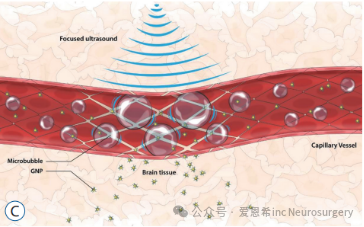 图3.A: 磁共振引导聚焦超声(MRgFUS)临床前系统示意图。B: 聚焦超声(FUS)递送导致肿瘤内血脑屏障(BBB)暂时性破坏的示意图。C: 聚焦超声对血管内微泡的作用及其导致BBB破坏的示意图，展示了金纳米颗粒(GNPs)的递送过程。