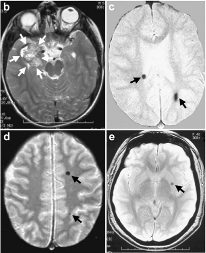 b. 轴位T2加权磁共振成像(MRI)显示先证者(家系图中箭头所指)右侧颞叶内侧大型海绵状血管畸形(白色箭头)，该病灶在显微手术切除前被检出。 c. 梯度回波MRI于双侧大脑半球发现多发性无症状海绵状血管畸形(黑色箭头)。 d. 患儿父亲的轴位梯度回波MRI显示左额叶及顶叶两处小型无症状海绵状血管畸形(箭头)。 e. 家系中一位姑姑(II-5)同样在左侧基底节区检出无症状海绵状血管畸形(箭头)。