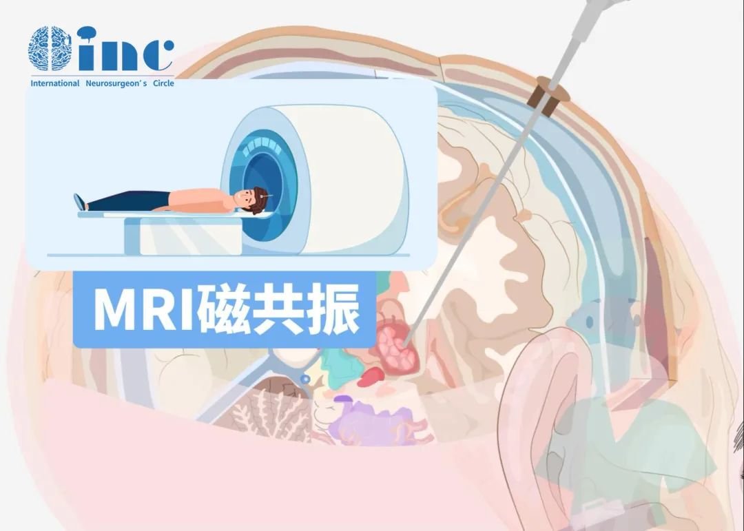 磁共振成像(MRI)是影像学诊断和评估的首选方法。
