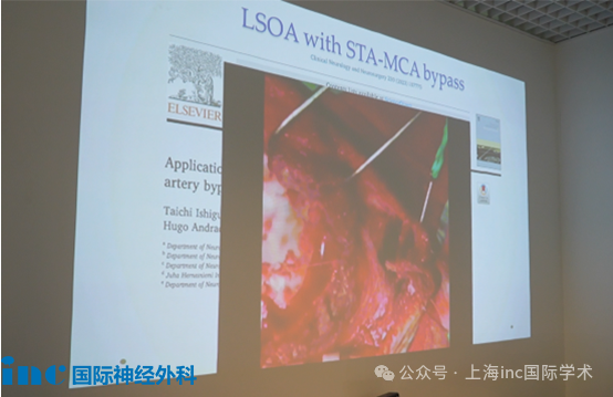 INC川岛明次教授学术沙龙研讨会上的学术展示，关于血运重建技术