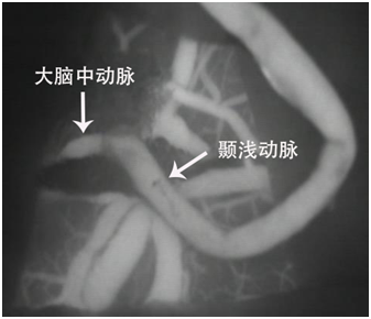 脑动脉