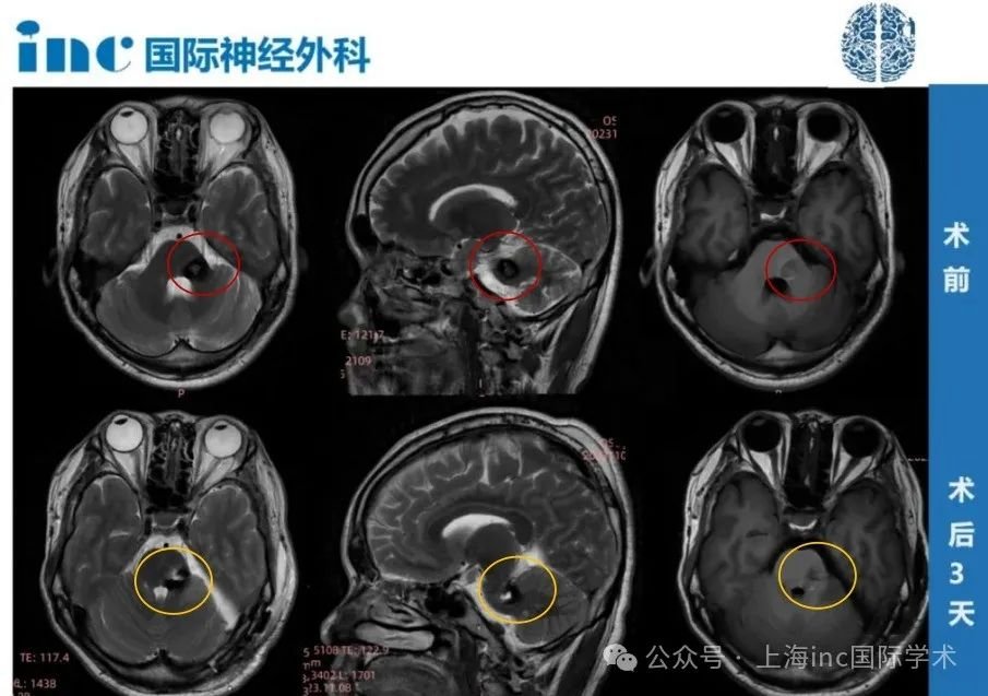 术后第1天，卢先生就从ICU，转入普通病房，术前他所担心的面瘫也都没有发生。