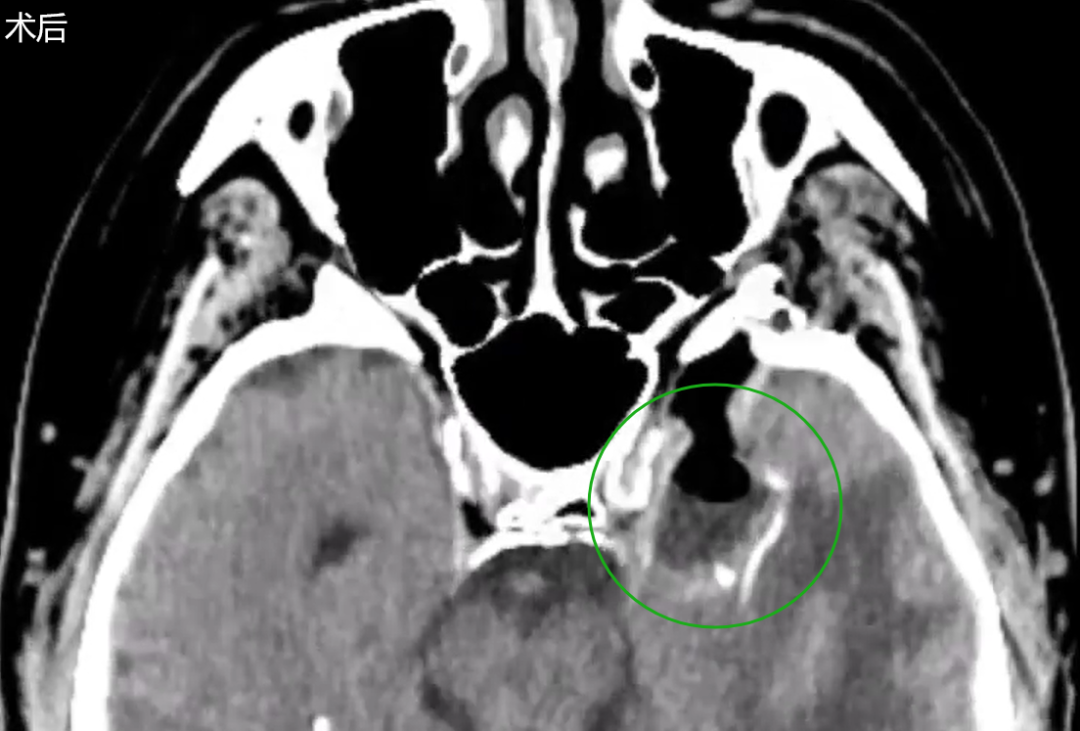 术后MRI