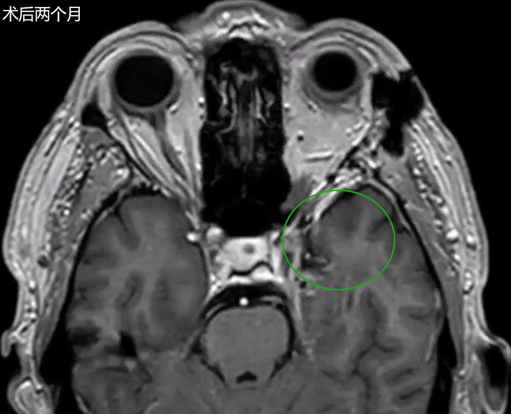 术后两个月MRI