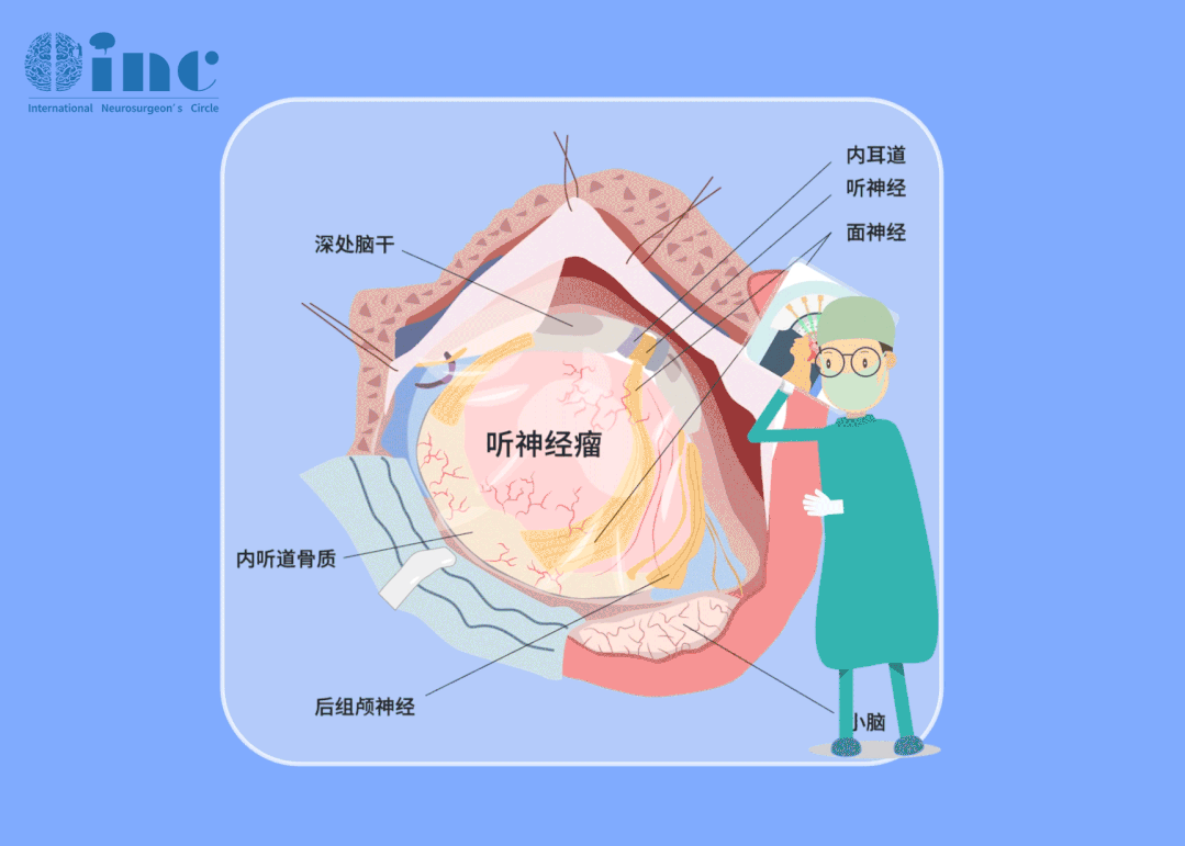 听神经瘤治疗理念先于手术，需要在保面、保听的先行理念下谨慎进行手术切除。放眼全球，国外的诊疗早已将“尽可能全切”、“不面瘫”、“保留听力”三要素作为听神经瘤手术成功的标准，功能保留逐渐成为治疗的首要目标。