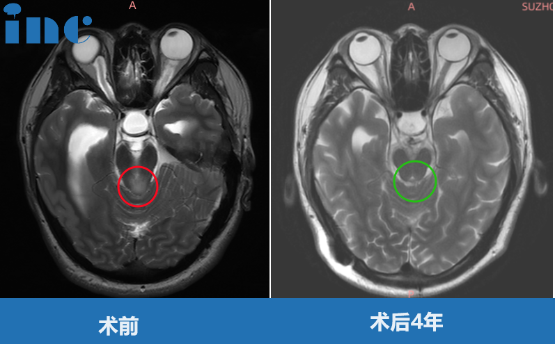 罹患中脑顶盖肿瘤，被判无法手术的他：“如今我当爸爸了！”
