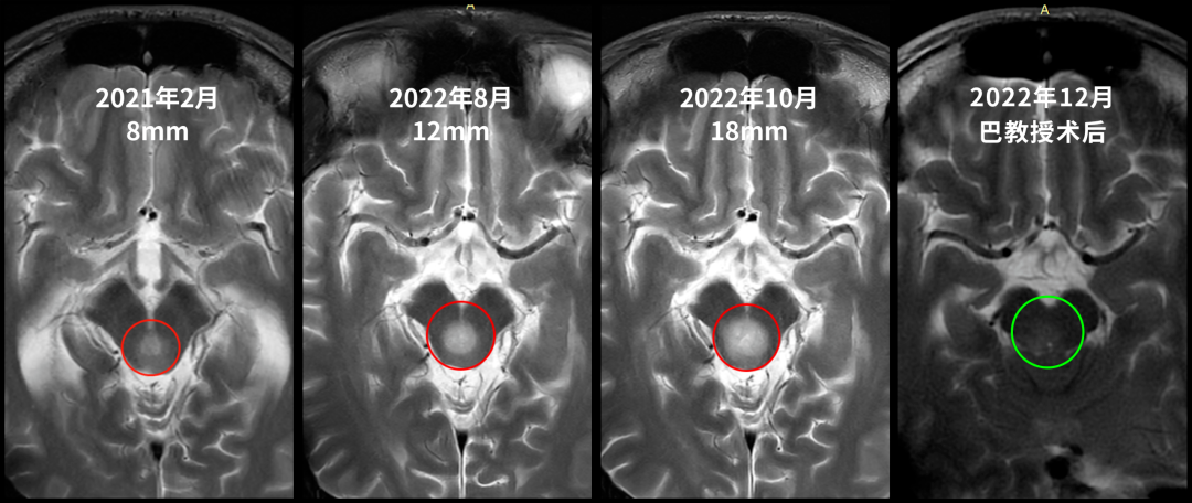 21岁的张远2021年确诊中脑顶盖肿瘤（8mm），因位置险要被告知无法手术；至2022年肿瘤快速增长至18mm并引发严重神经症状，最终由巴教授成功完成近全切手术，病理证实为2级多形性黄色星形细胞瘤，术后功能完好