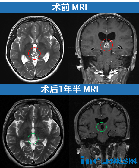 松果体区肿瘤案例图片
