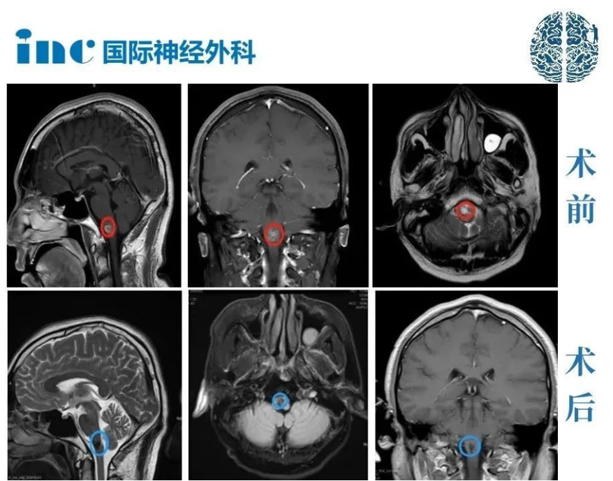脑干海绵状血管瘤手术：INC神经外科团队解析高难度手术策略与预后管理