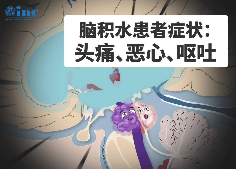脑积水患者症状：头痛、恶心、呕吐