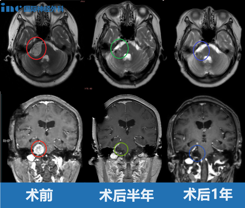 听神经瘤挤压变形