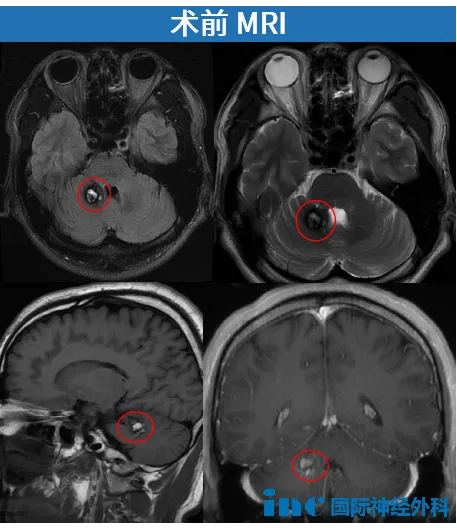 术前MRI