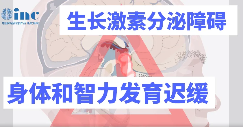 警惕颅咽管瘤！孩子生长发育的 “拦路虎”