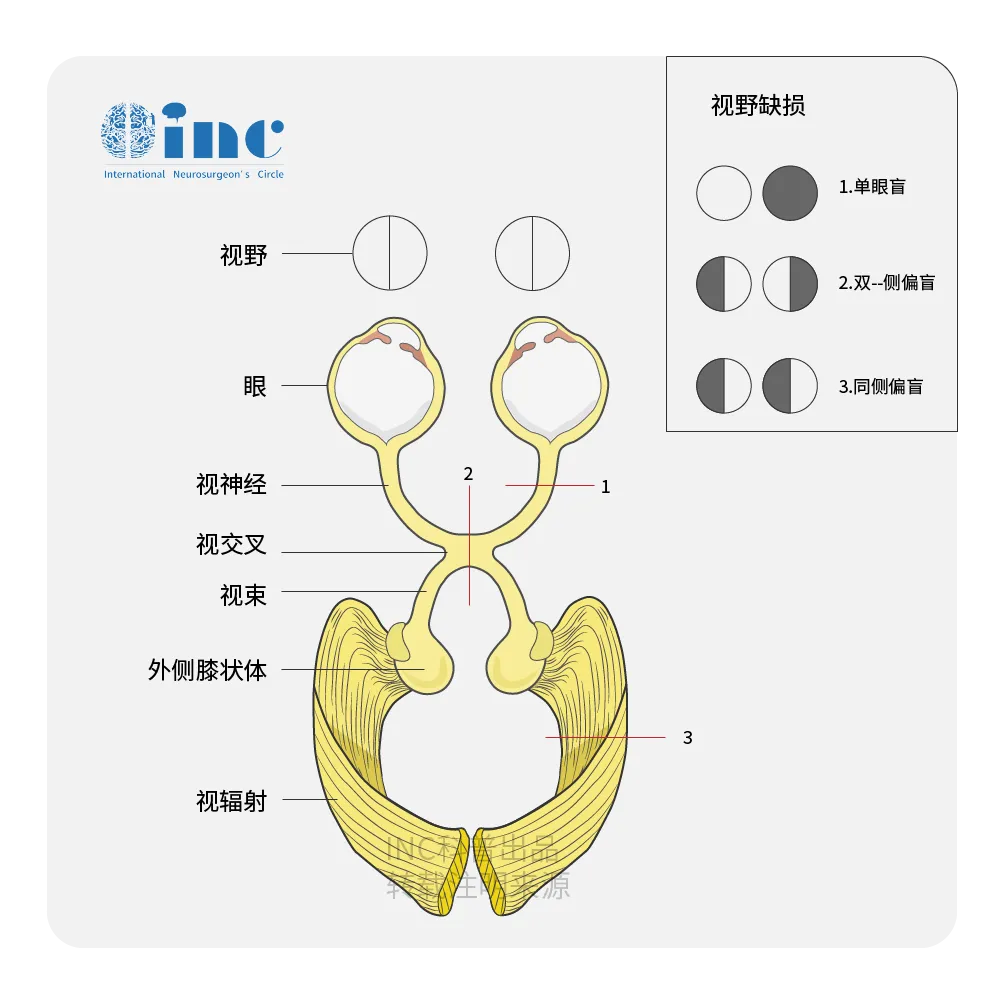视束继发受累