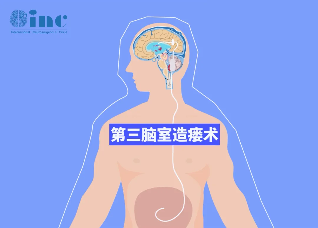 神经内镜下第三脑室造瘘术