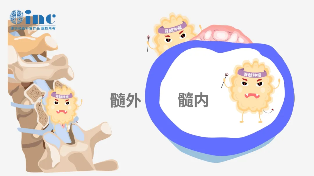 脊髓内肿瘤与髓外肿瘤的区别