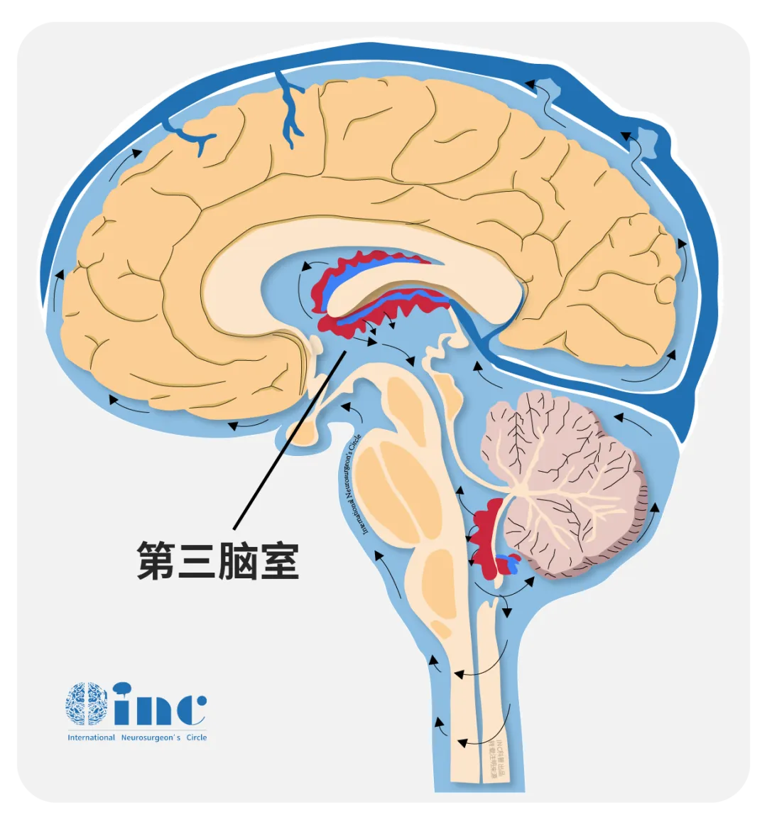 什么是脑脊液漏？