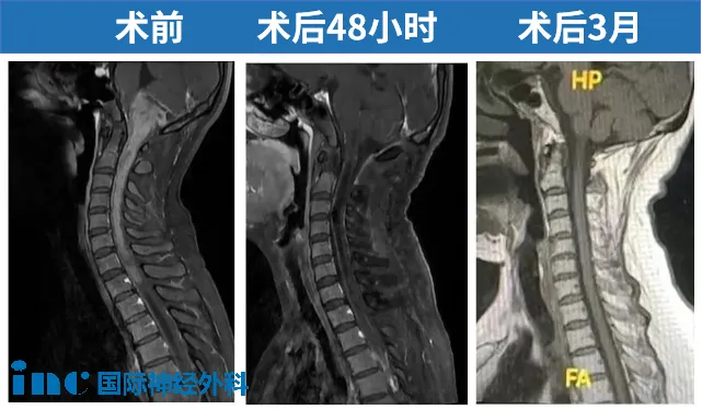 术前术后MRI对比