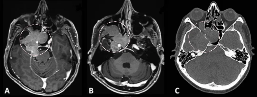 患者术前影像。（A）术前轴位T1加权钆增强磁共振成像（MRI），显示脑膜瘤延伸至后颅窝、海绵窦、眼眶和蝶窦。（B）肿瘤延伸至中颅窝、翼腭窝和颞下窝。（C）术前轴位计算机断层扫描（CT）显示蝶骨大翼侵蚀和蝶窦受累。