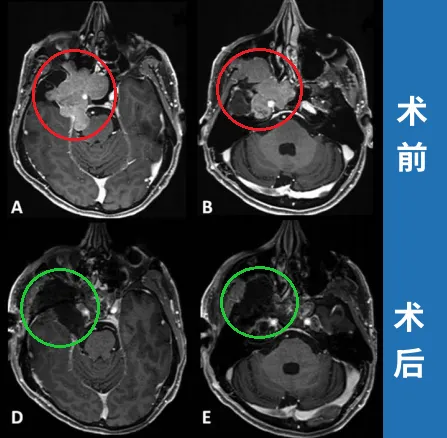 (A)术前轴向t1加权钆增强磁共振成像(MRI)显示脑膜瘤延伸至后颅窝(PF)、海绵窦(CS)、眼眶和蝶窦(SS)。(B)肿瘤延伸至中窝、翼腭窝(PPF)和颞下窝(ITF)。(D, E)术后轴向t1加权钆增强MRI显示肿瘤完全切除。