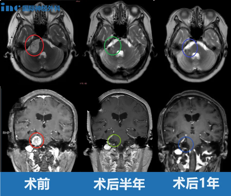 小心脑干被听神经瘤挤压变形