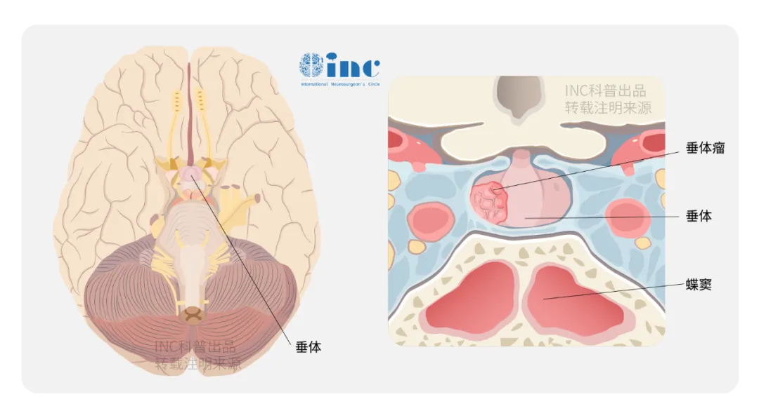 小小垂体瘤或藏致命危机，具备这4个特点即为难治性垂体瘤