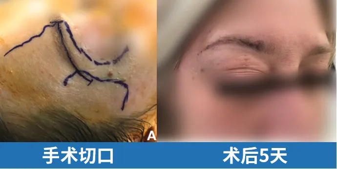 手术切口及术后5天恢复情况