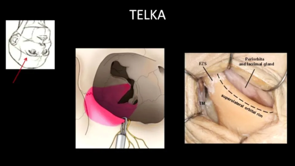 TELKA