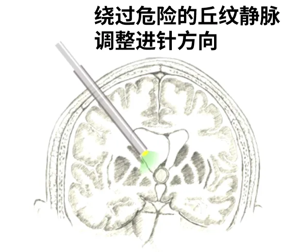 绕过危险得丘纹静脉调整进针方向