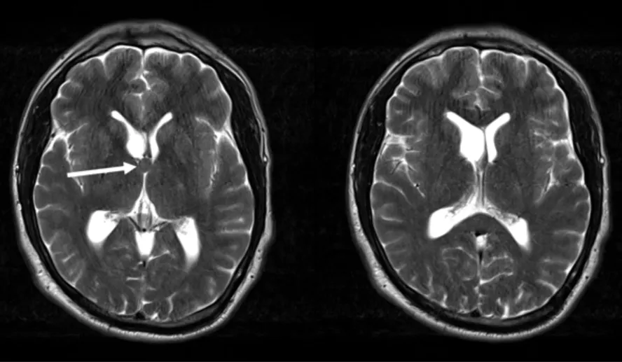 术前 MRI 显示此处静脉纹极为显著