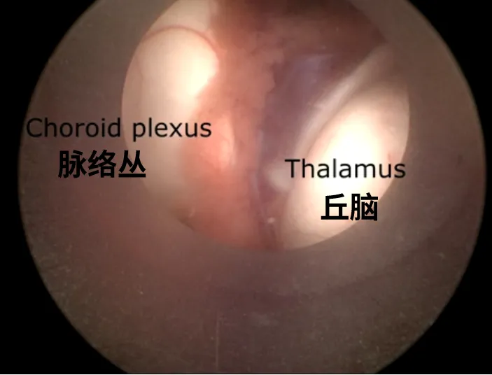 脉络丛和丘脑